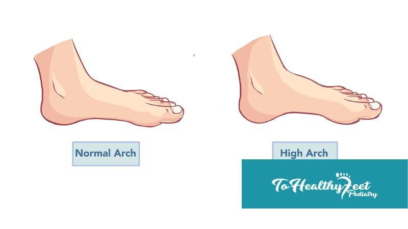 To Healthy Feet Podiatry High Arched Feet Causes and Diagnosis